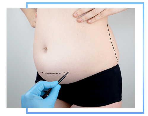 Tummy Tuck 1