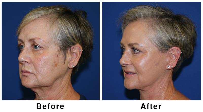 FL1 before and after