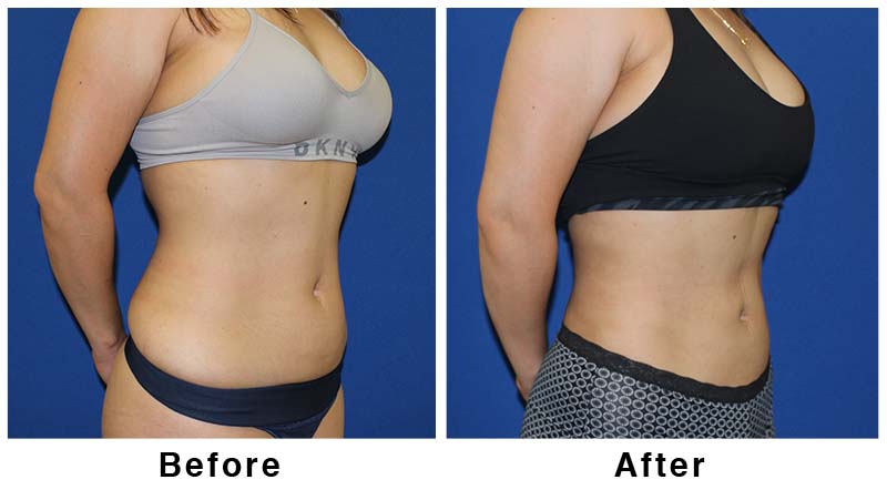 Lipo1 before and after