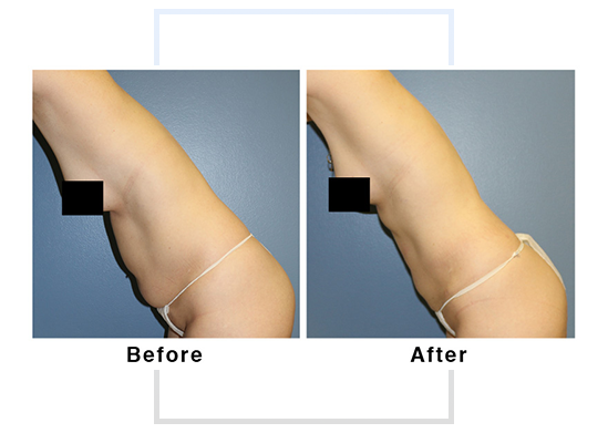 lipo 1