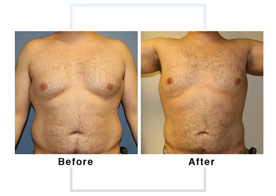 lipo 2