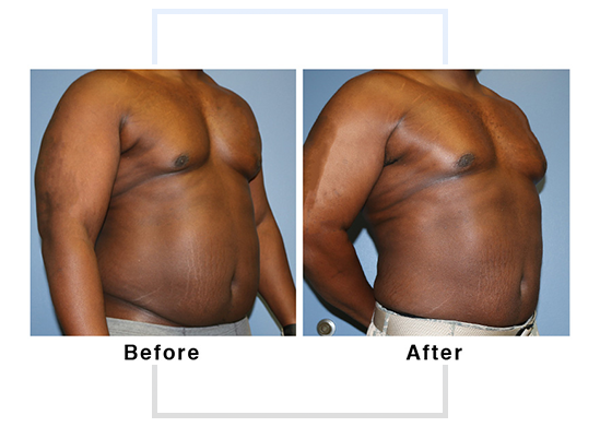 lipo 3
