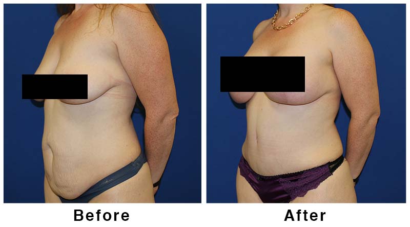 mommakeover-2-before-and-after-1