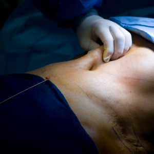 liposuction surgery