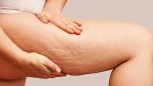 cellulite