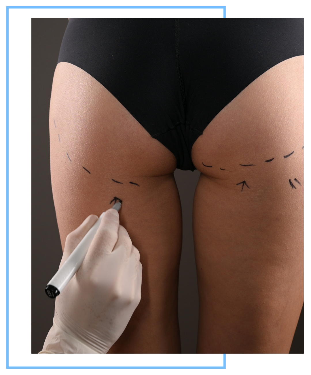 img of a butt lift