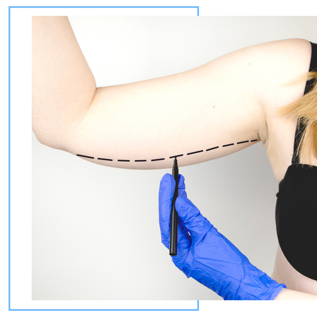 arm lift concept