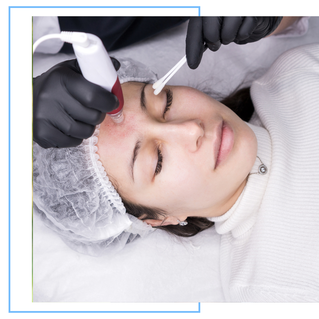 Microneedling3
